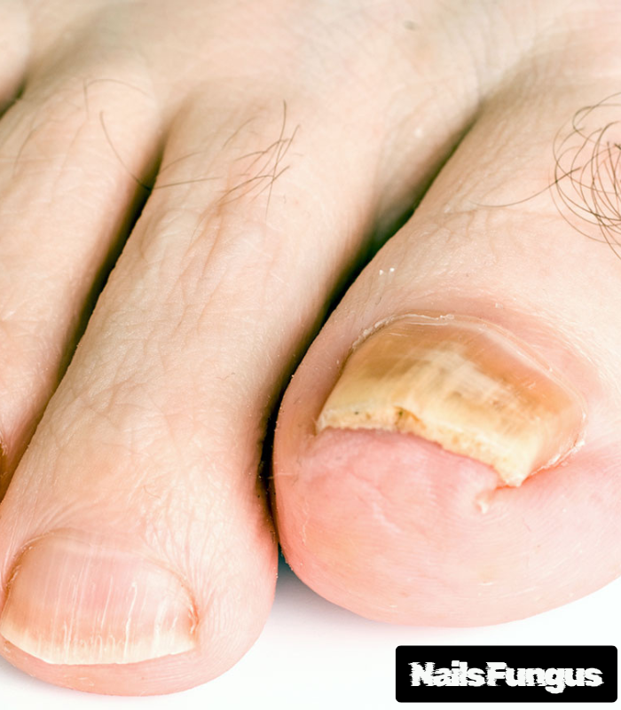 Can Bleach Kill Nail Fungus? 2025 Verdict – Safe or Risky?